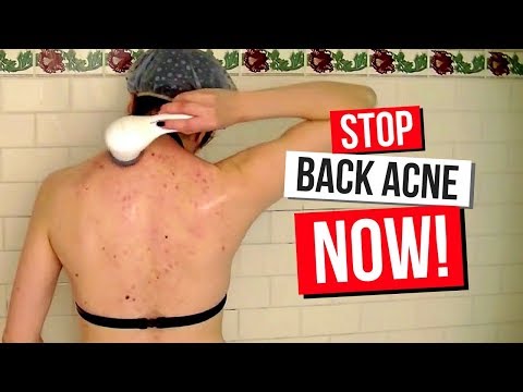 how to i get rid of back acne scars