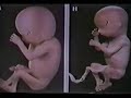aborto   parte 3