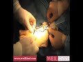 Cobb Tibialis Anterior Tendon Transfer Cobb Tibialis Anterior Tendon Transfer
