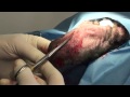 Ear Infections and Hematoma Surgery in a Dog
