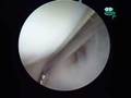 Wrist arthroscopy