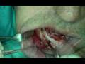 oral surgery video preview 09