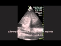 Pulmonary Hepatization Pulmonary Hepatization