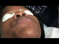 Expert Pimple Popping in progress...