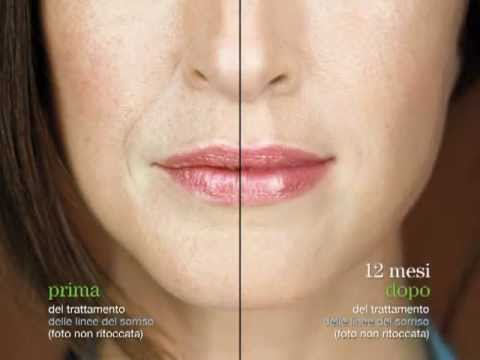 Evolence Il filler che non richiede test cutanei preliminari