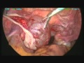 Benign Ovarian Cyst - Laparoscopic Excision Benign Ovarian Cyst - Laparoscopic Excision