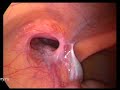 Testicular retention in adult with bilateral groin hernias