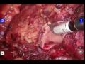 Robotic Assisted Anterior Pelvic Exenteration