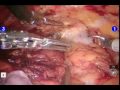 Robotic Assisted Anterior Pelvic Exenteration Robotic Assisted Anterior Pelvic Exenteration