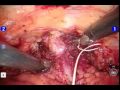Robotic Assisted Anterior Pelvic Exenteration