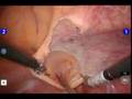 Robotic Assisted Anterior Pelvic Exenteration