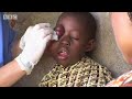 Medical volunteers try to help a young boy who has eye cancer in Sierra Leone, Africa - BBC Eye Cancer