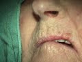 Part 2- Immediate implantation for an elderly patient.