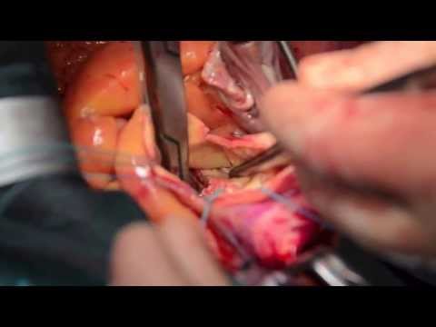 Prótesis Sutureless - Injerto de mamaria a descendente anterior - Ablación de fibrilación auricular