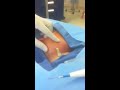 Draining a Neck Abscess- Dr. Alvi