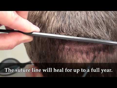 how to remove hair transplant scar
