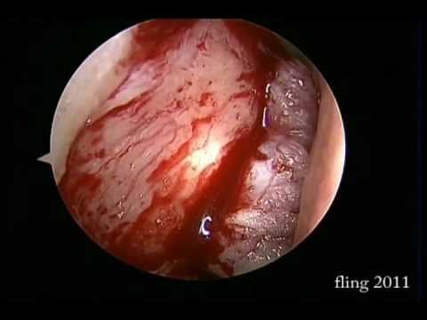 Dacryocystorhinostomy (DCR) - Endoscopy