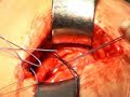 Rotator cuff tear miniopen repair ????????????????? ???????? Rotator cuff tear miniopen repair ????????????????? ????????