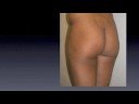 Buttock augmentation Buttock augmentation