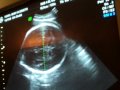 39 Weeks Pregnant Sonogram