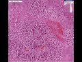 Histopathology Liver--Cardiac sclerosis (cardiac cirrhosis) Cirrhosis