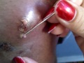 spider bite 1