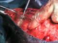 videos de Equine mastectomy - Lotus hook