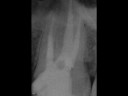 CASOS CLINICOS ENDODONTIA-DR. FLAVIO PRISCO