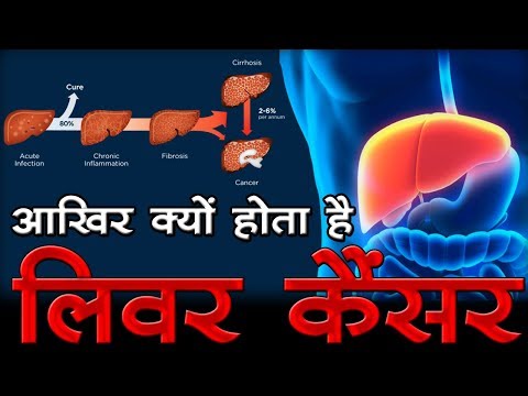 आखिर क्यों होता है - लिवर कैंसर liver cancer causes and treatment