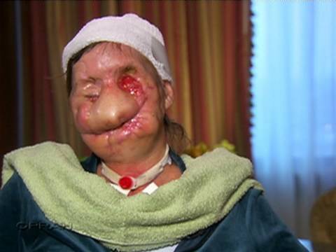 Woman Shows Face After Chimp Attack – GRAPHIC VIDEO