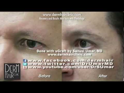 how to transplant eyebrows