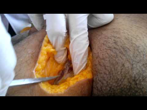 embalming - Tracing of femoral artery for injection of embalming fluid by embalming machine.