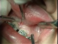 Frenectomy And Diastema closure