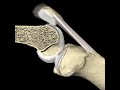 Knee Flexion & Patellar Motion Animation, ©Primal Pictures Ltd