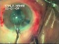 Phacoemulsification in Challenging cases by Dr. Sudhalkar