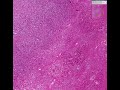 Histopathology Liver--Cirrhosis, hepatocellular carcinoma