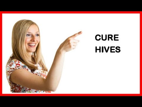 how to cure idiopathic urticaria