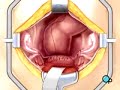 PreOp® Patient Education:  Hysterectomy Removal Uterus 2
