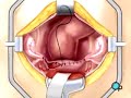 PreOp® Patient Education:  Hysterectomy Removal Uterus 2