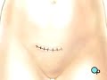 PreOp® Patient Education:  Hysterectomy Removal Uterus 2