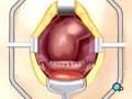 PreOp-Patient-Educat