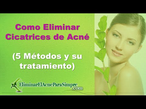 Como Eliminar Cicatrices de Acne (5 Métodos y su tratamiento)