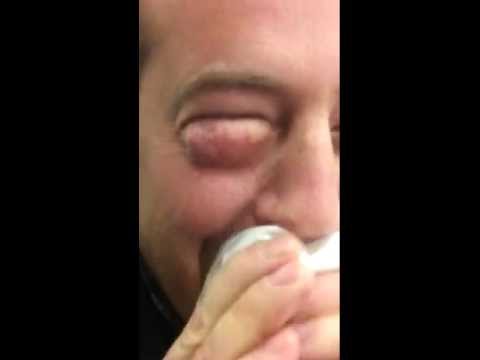 how to drain eye when puffy