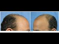 DM - NW 6 (6310 grafts) 6 month update