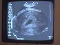 Ultrasound at 6 weeks #4