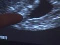 Ultrasound at 6 weeks #4