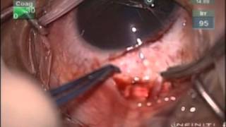 AGV in Sturge Weber Syndrome