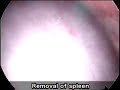 Laparoscopic splenectomy and devascularization Laparoscopic splenectomy and devascularization