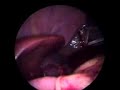 Explenectomia Laparoscopica Explenectomia Laparoscopica