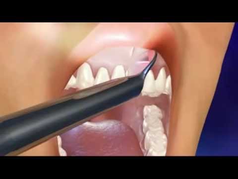 how to cure oral cancer